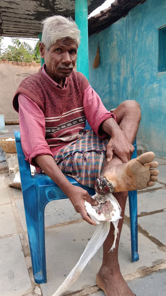 पैर का घाव